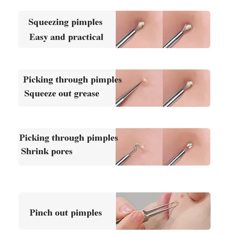 Higt Quality Acne Blackhead Re - Luxury Skincare Acne review and price